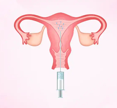 IUI